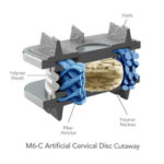 Die M6 Bandscheibenprothese überzeugt mit ihrer eleganten Biomechanik (c) spinalkinetics.com